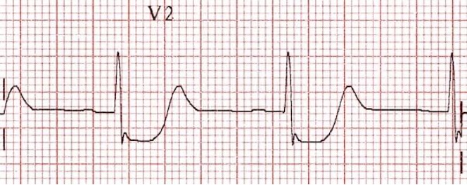 OMI, NOMI, and EMS: The Case for EMS Recognition of Occlusive MI