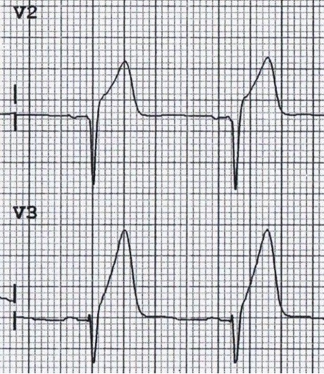 OMI, NOMI, and EMS: The Case for EMS Recognition of Occlusive MI