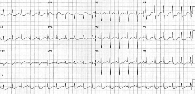 OMI, NOMI, and EMS: The Case for EMS Recognition of Occlusive MI