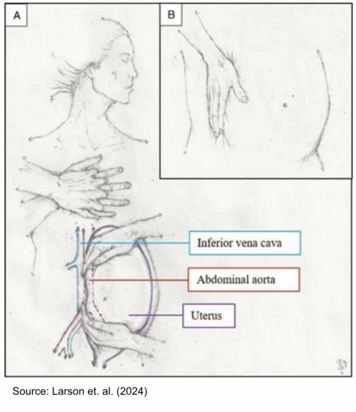 Maternal Cardiac Arrest: Physiologic Considerations, Resuscitation Modifications, and Resuscitative Hysterotomy