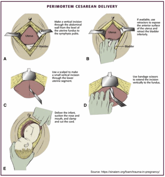 Maternal Cardiac Arrest: Physiologic Considerations, Resuscitation Modifications, and Resuscitative Hysterotomy